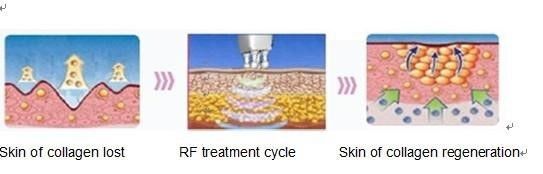 Uitleg over hoe de RF behandeling werkt
